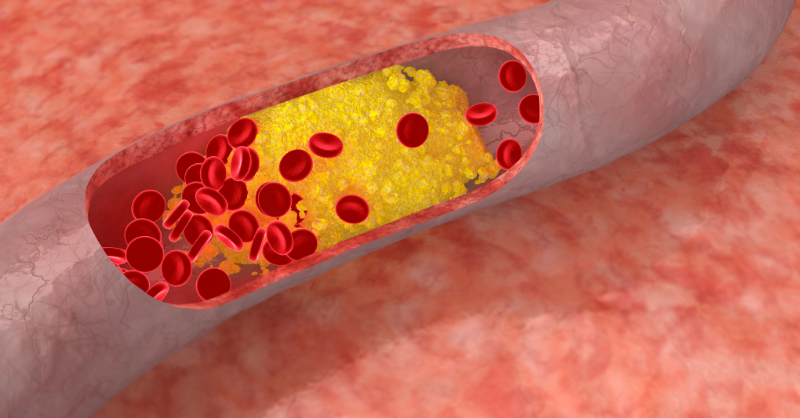A virtual representation of high cholesterol in the bloodstream