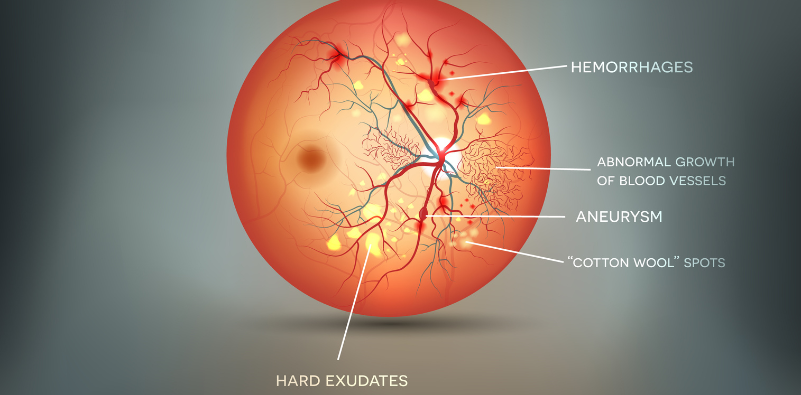 Diabetic retinopathy detailed anatomy on an abstract grey mesh background